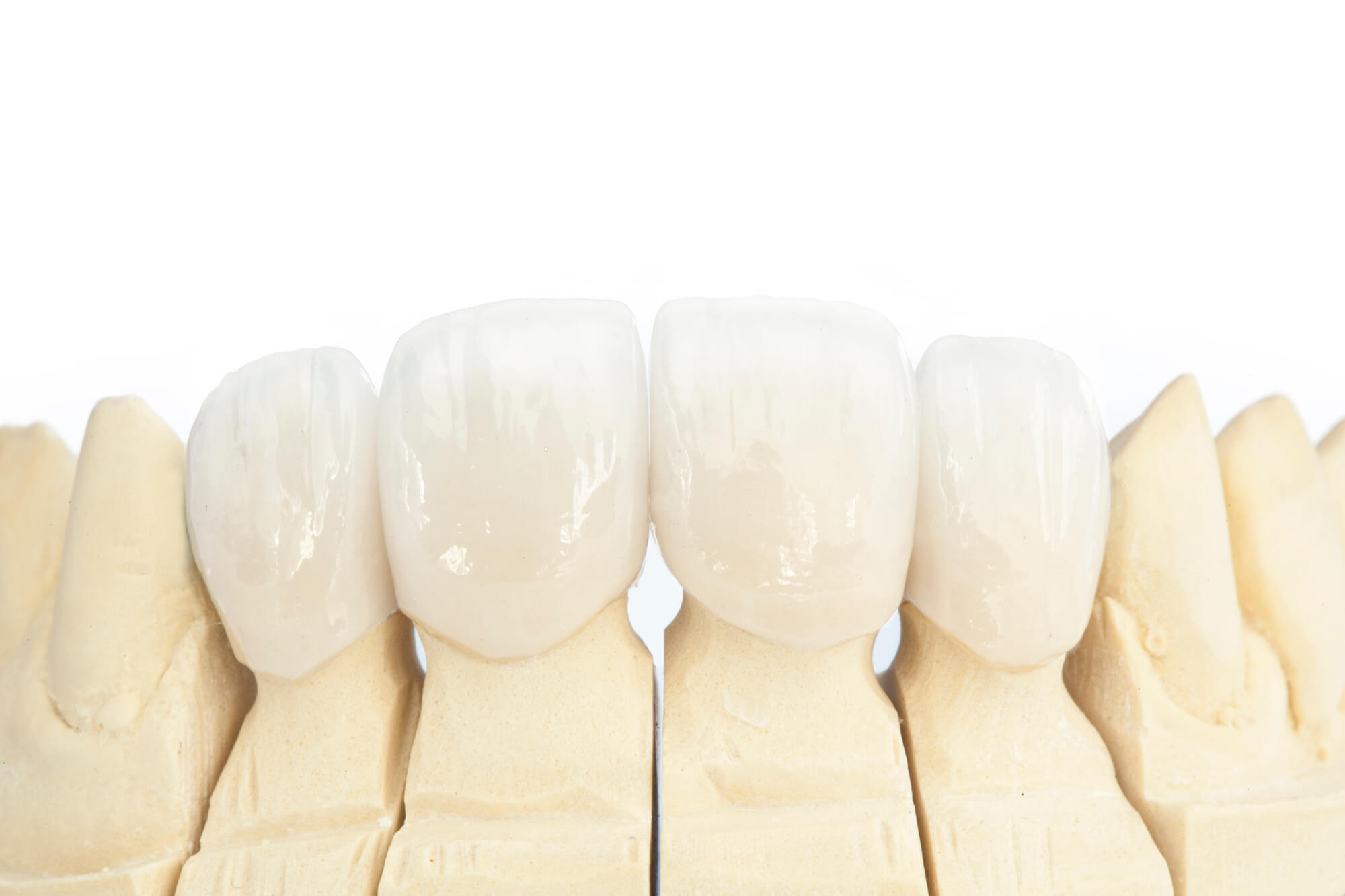 3D model of teeth with same-day crowns in Murray Hill