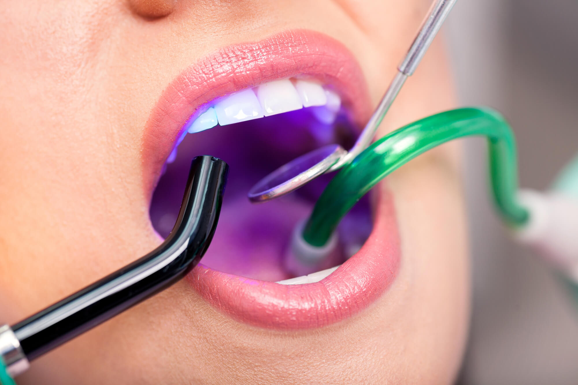 Doctor performing Laser Dentistry in midtown Manhattan on a patient