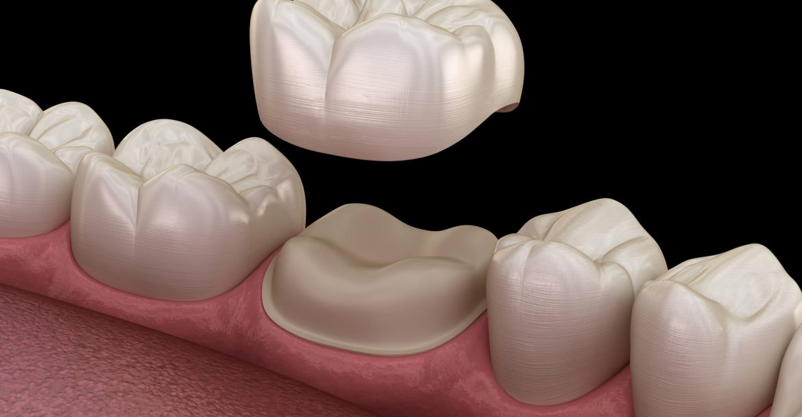 3d representation of a same-day crown in Murray hill