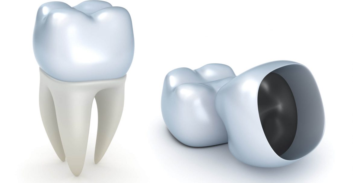 a closer look at same day crowns in Murray Hill