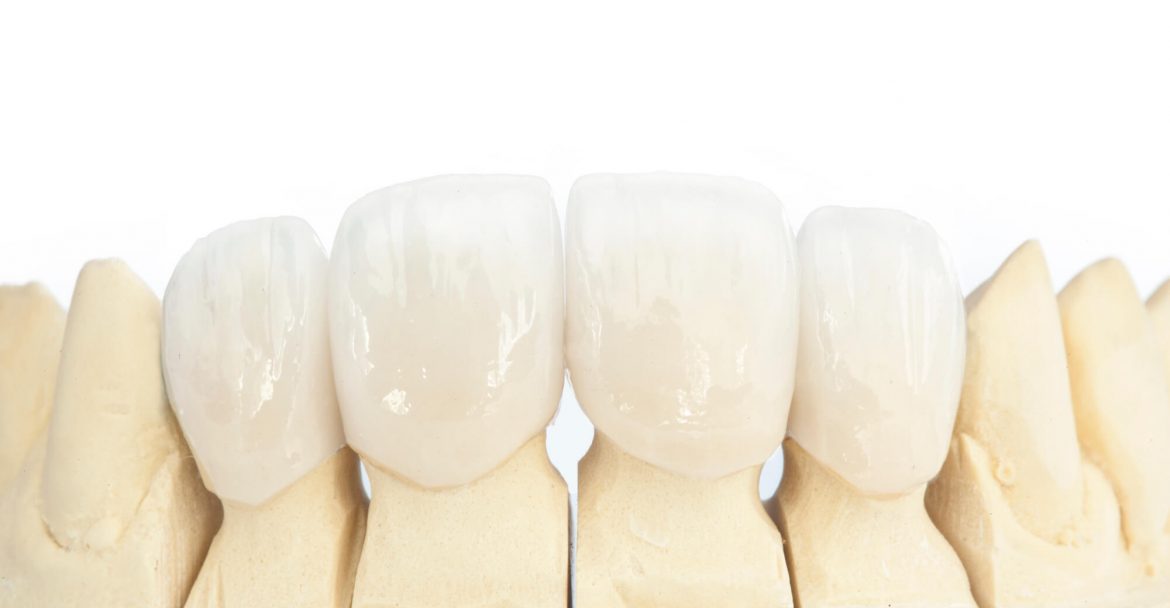 3D model of teeth with same-day crowns in Murray Hill