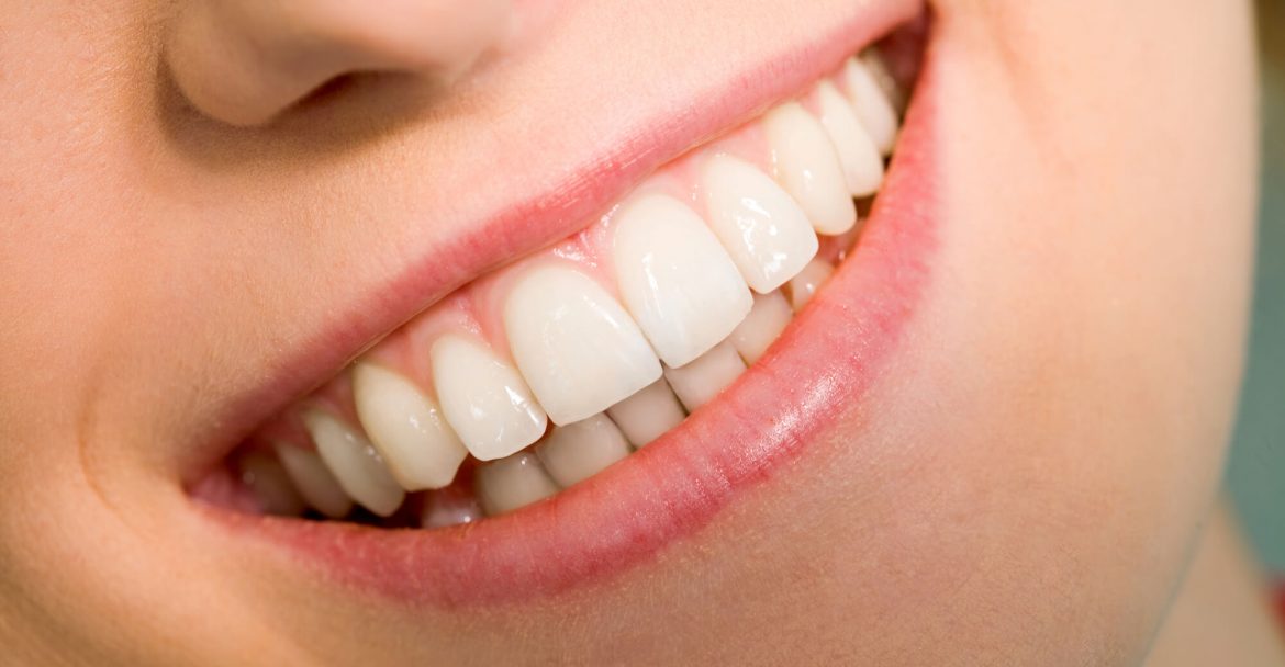 smiling after Gum bleaching Hells kitchen